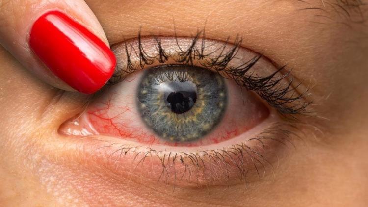 Œil rouge et irritation par corps étranger