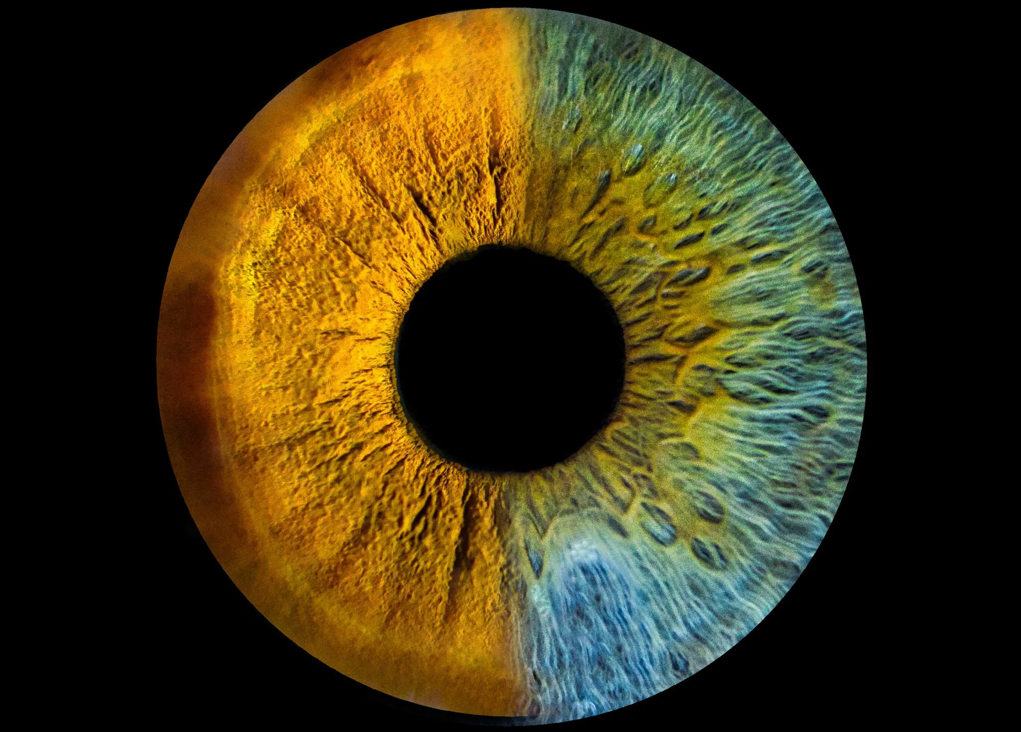 Evaluez la sécheresse oculaire avant laser